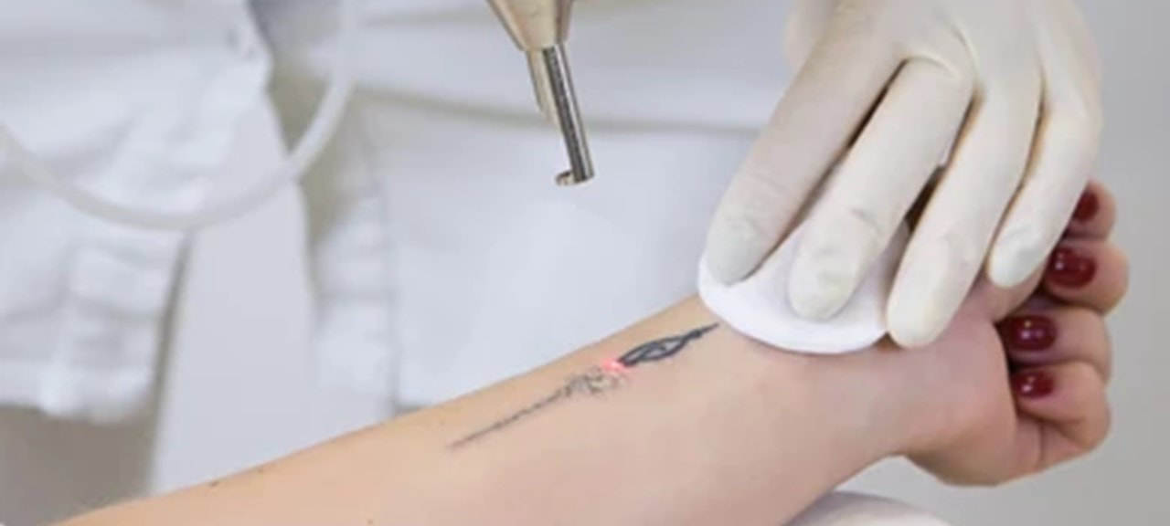 A women undergoing laser treatment to remove tattoo - Laser Therapy - Lake Charles LA - Dermatology Associates SWLA
