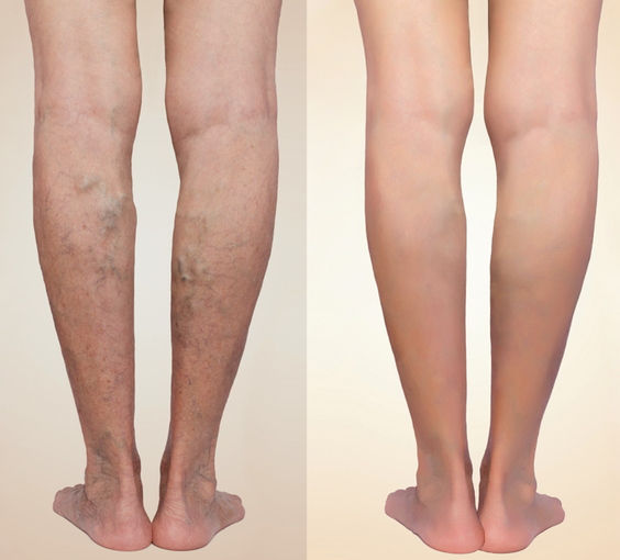 spider vein leg treatment before and after 